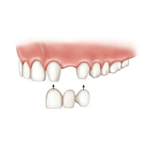 Exercising Chewing Function Dental Crown Bridge Pure Titanium Oral Hygiene