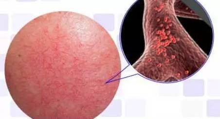 машина вены потока удаления 20W лазера диода 10-260ms 980nm васкулярная