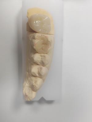 Dental Inlay And Onlay For Indirect Filling And Tooth-Colored Restoration