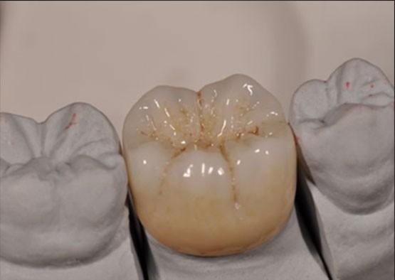 High Aesthetic Noritake Zirconia Natural Color Stable For Full Zirconia Crown