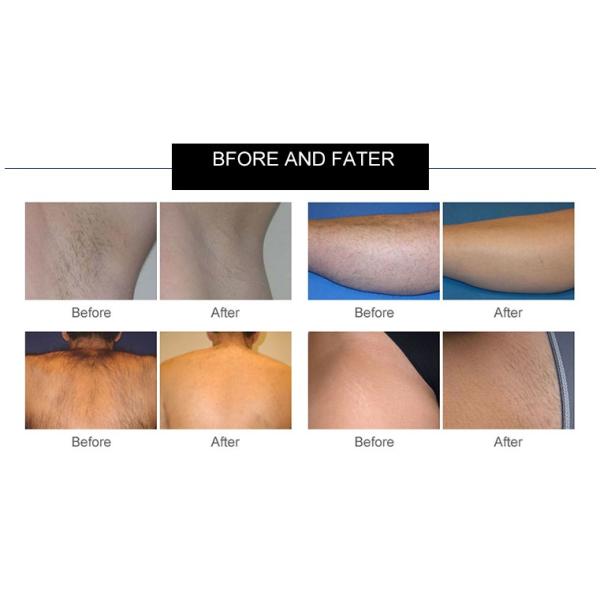 Portable 808nm Diode Laser Hair Removal Machine With CE Approvel