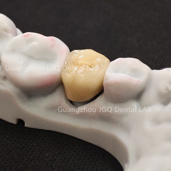 Metal Ceramic Crowns Custom Fixed Prosthesis Pfm Long Bridge 3D Laser Printing