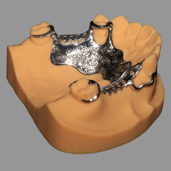 3D Printed CoCr Metal Framework Partial Nickel Free Lightweight