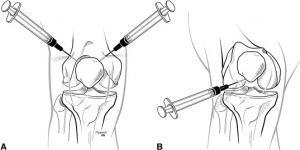 High Purified Hyaluronic Acid Injections For Knee Pain / Orthopedics Knee Injection Reliev