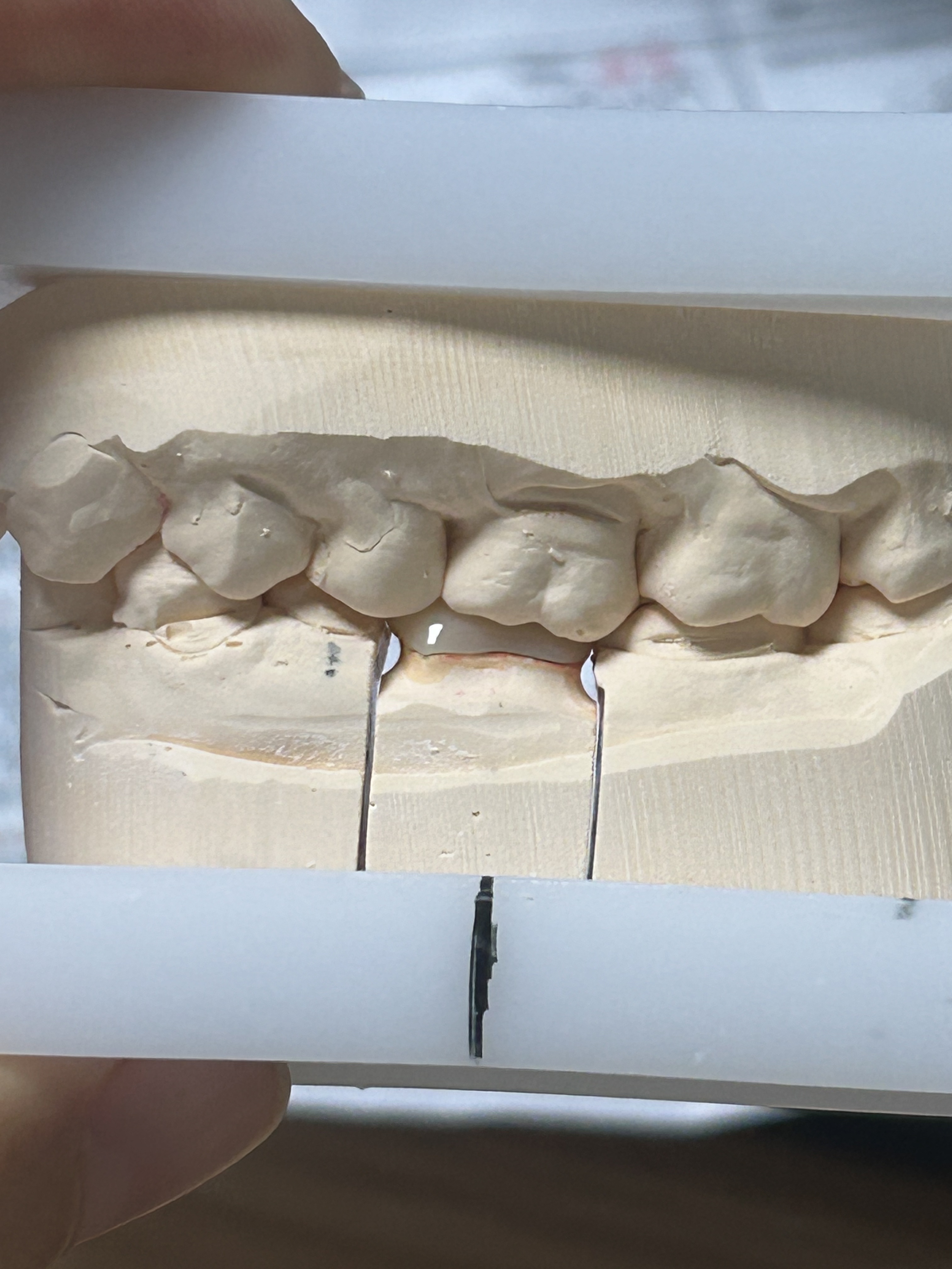 High-Strength Dental Zirconia Crown with Patient-Specific Digital Design and CAD/CAM Production for Posterior Teeth