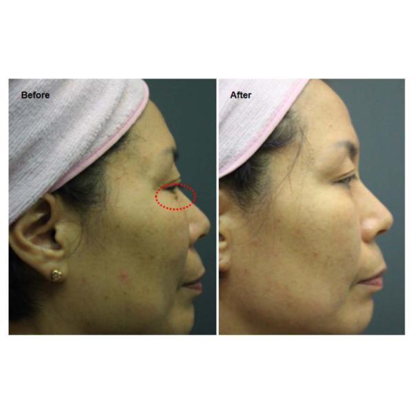 Skin Lifting Skin Rejuvenation Machine For Acne Removal Eyelid Lifting