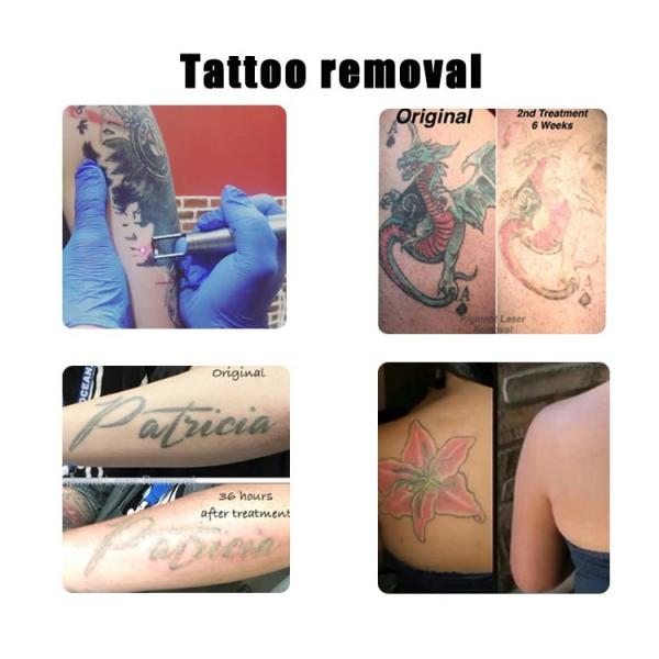 Portable 532nm 1320nm 1064nm Q cambió la eliminación de tatuajes de la máquina láser Nd Yag