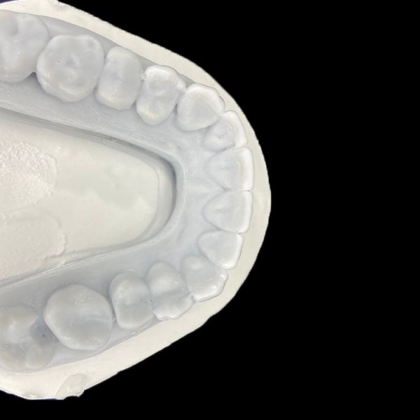 Diagnostic Wax-Up for Porcelain Veneers