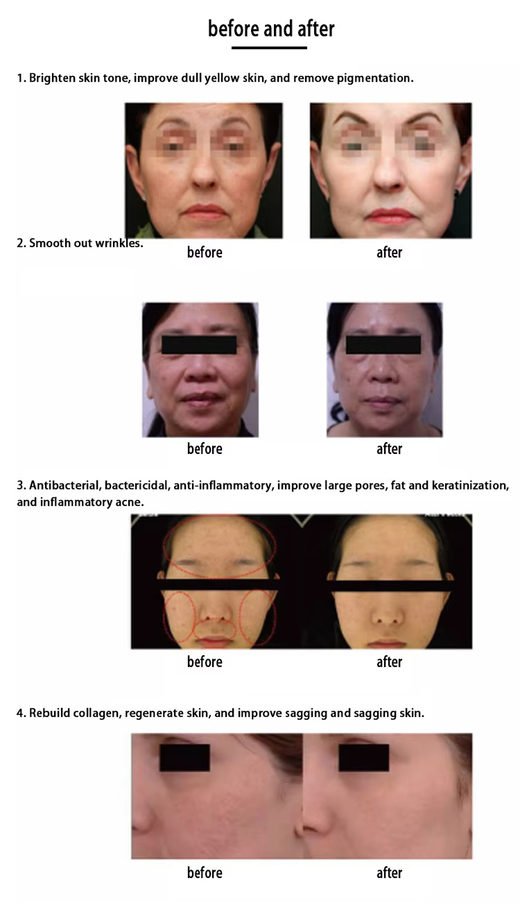 Non Invasive 2 Handles Anti Aging Ance Removal Ultrasonic Ceramic Space Plasma Machine