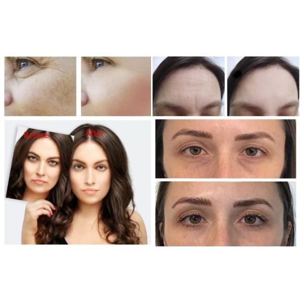 продолжительное шприца 1ml 2ml Hyaluronic кисловочное вводимое для глубоких морщинок