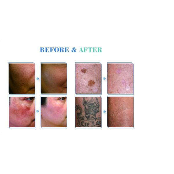 Nd Yag Laser beauty equipment Nubway pico laser tattoo removal machine picosure laser