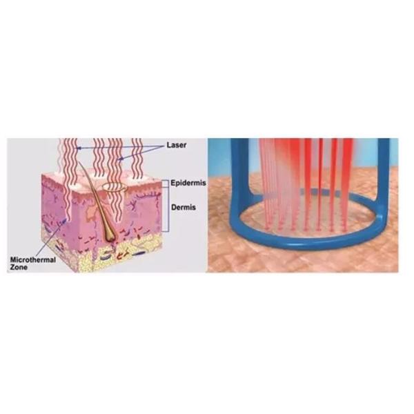 Fractional Co2 Laser Skin Resurfacing Machine With 10.6um Wavelength