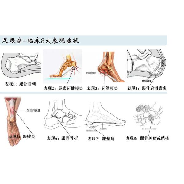 Heel Spur Pain Relief Patch Herbal Calcaneal Spur Rapid Heel Pain Relief Patch Foot Care Treatment Plaster