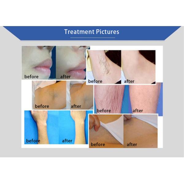 Home Use Permanent 808nm Diode Laser Treatment For Hair Removal 2000W