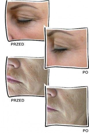 Beauty Equipment Hot Sale Fractional Rf Microneedle Skin Solution Beauty Tighten Machine