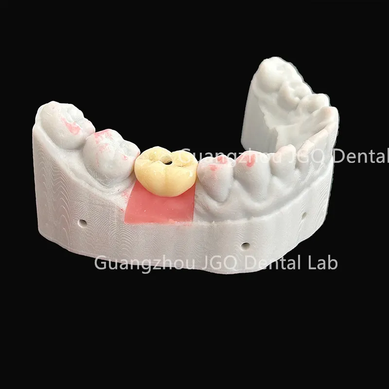 Dental Lab Durability Implants Make Cost-Effective Option in The Long Run