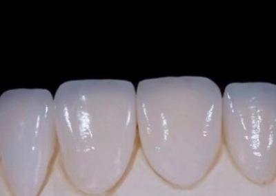 EMAX    Durablity CAD/CAM Dental Composite Veneers Highly Detailed Accurate