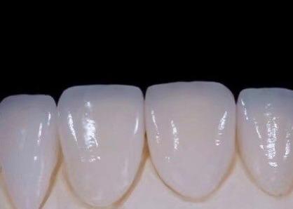 EMAX    Durablity CAD/CAM Dental Composite Veneers Highly Detailed Accurate