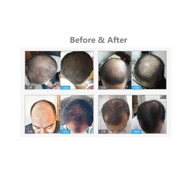 650nm Portable LLLT Laser Diodes Hair Regrowth Cap For Home Use