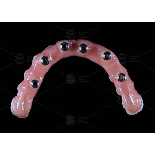 China Dental Lab Titanium Screw Retained Malong Design A1 Shade Full Arch Hybrid Bridge