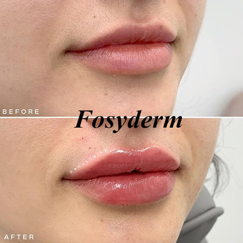 1ml 2ml 10ml Injectable Dermal Filler , Cross Linked Hyaluronic Dermal Fillers Ha