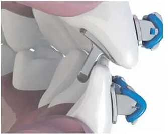 Professional Bite Opener for Dental Orthodontics - Adjustable Jaw Correction Tool