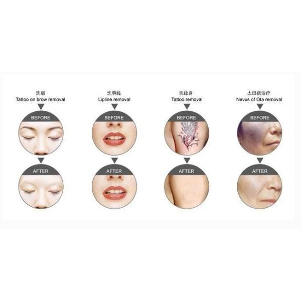 10ns 1064nm 5Hz Q Switch Laser Suitcase Cartridge оборудование для удаления татуировок