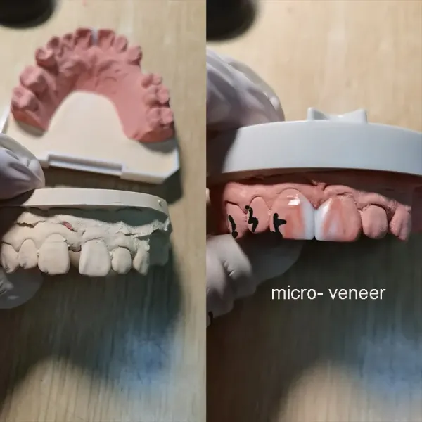 Permanent Restoration Full Contour Zirconia Crown Dental Implant with Custom Milled Titanium Frame