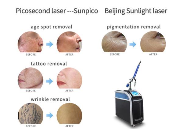 2000MJ Alexandrite Picosecond Laser Tattoo Removal Machine 755Nm Black And Blue