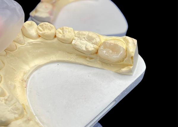 Dentária de inserção de cerâmica suave personalizada resistente à coloração de dentes Reparação de dentes sem costura