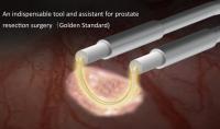 Hystéromyomectomie sonde gynécologique pour une invasivité minimale des tissus en décomposition