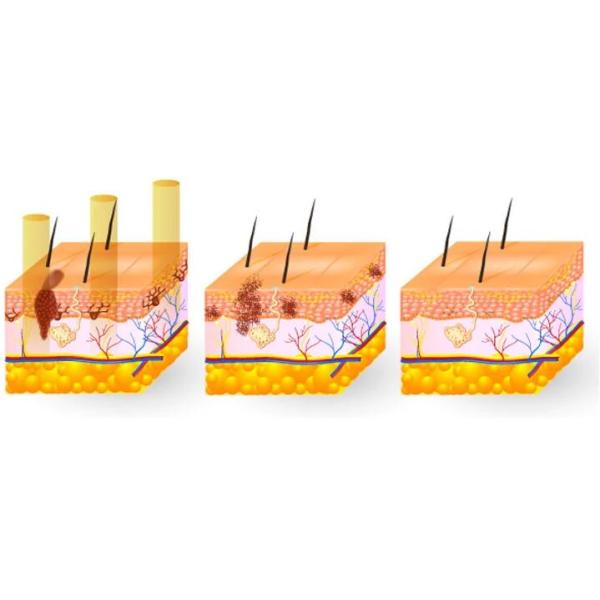 3 в 1 к переключил машину татуировки лазера НД Яг размер места 2 до 8мм