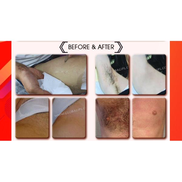 13*13mm2 Painless 808nm Diode Laser Hair Removal Machine