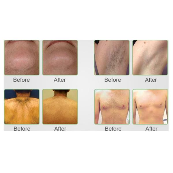 Triple Wavelength Diode Laser Hair Removal Machine For Home 1-10Hz