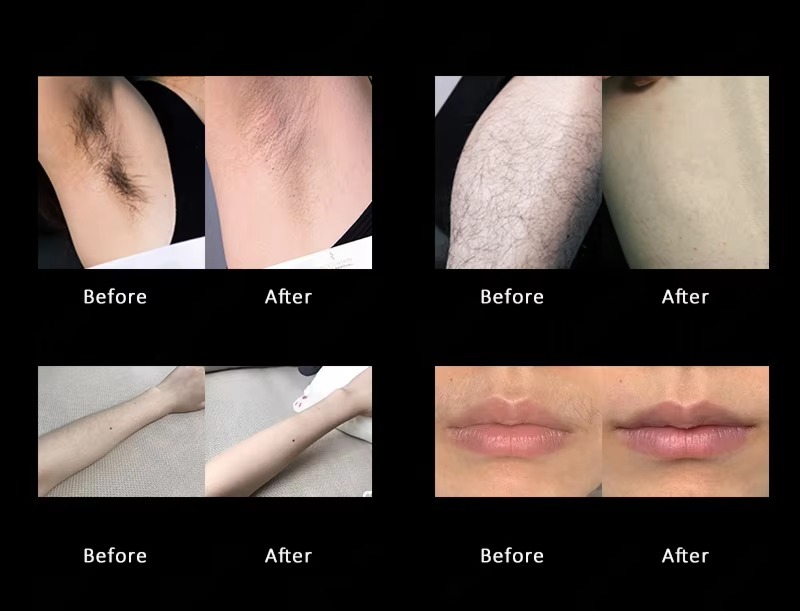 All In One Laser Hair Removal Tattoo Removal Pico Laser 808 diode 2in1