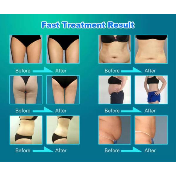 Переносная радиочастотная машина для похудения AU Plugs Ультразвуковая машина для кавитации жира