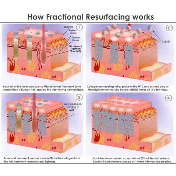 Serrage de la machine partielle de beauté de laser de CO2 de peau pour le retrait de cicatrice de colorant d'acné