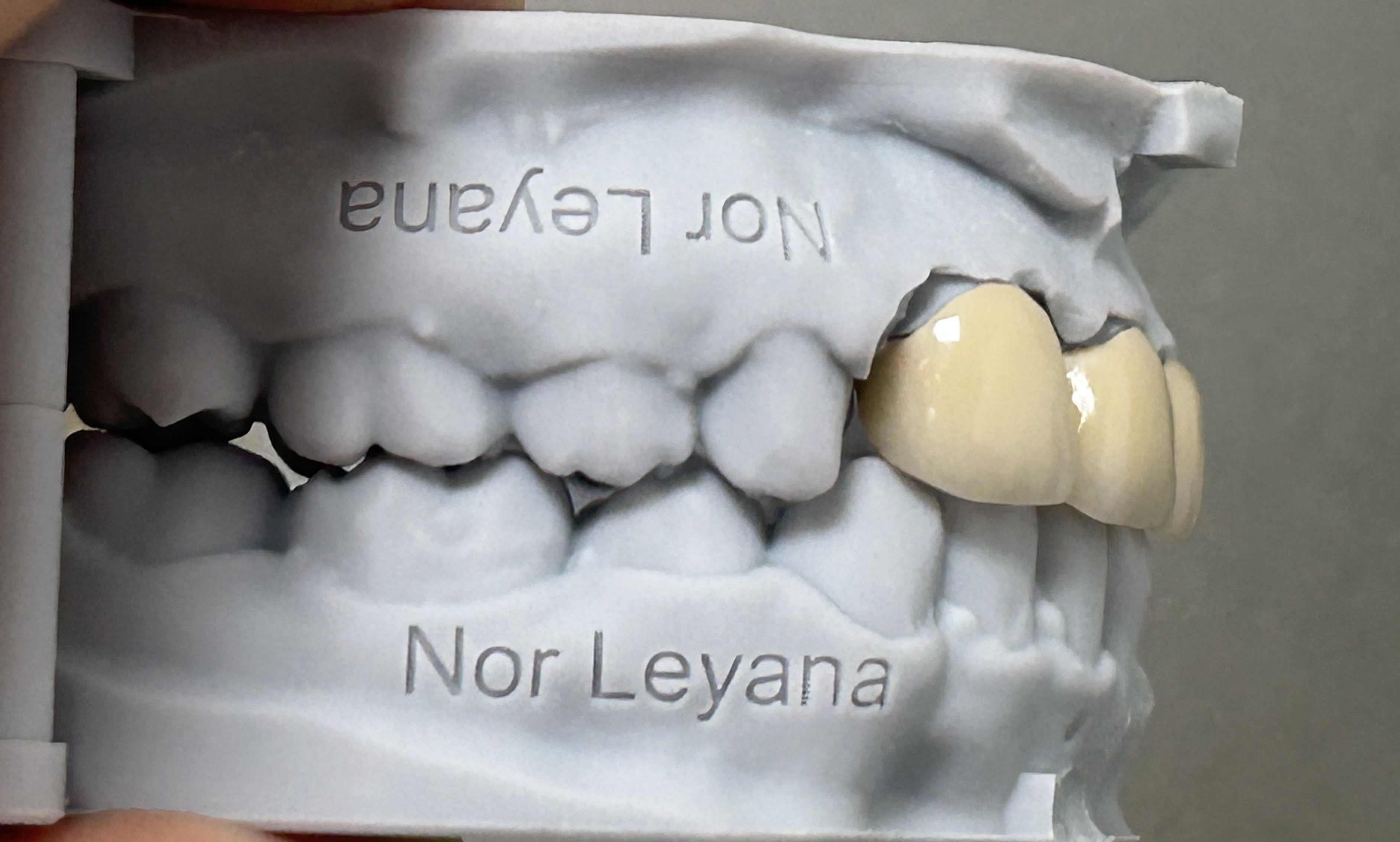 Cobalt Chrome PFM Crown from china dental lab