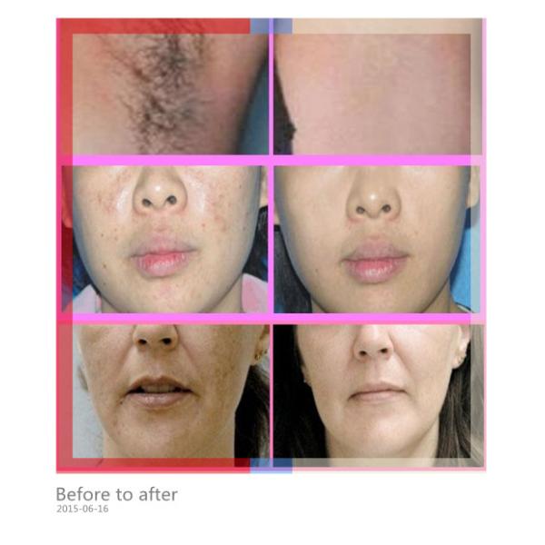 Face SHR Hair Removal Machine , E- Light IPL RF ND Yag Laser Hair Removal Machine