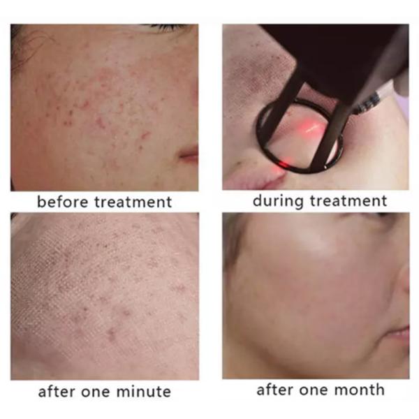 Portable CO2 Fractional Laser Machine For Acne Pigment Removal 10600nm Wavelength