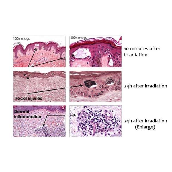 Máquina de eliminación de tatuajes sin dolor Q Switch Máquina de eliminación de tatuajes profesional 532nm