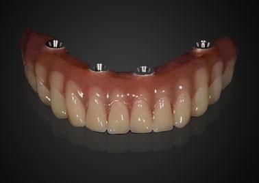 Customized Replacing Dental Implant Crown Wear Resistant For Long Term Use
