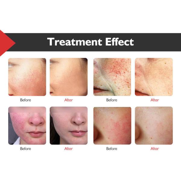 удаление пятна возраста тела стороны машины удаления вен паука 15ms-100ms 20W