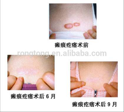 RF Tube Co2 Fractional Laser Technology Beauty Machine for Acne Scar Removal