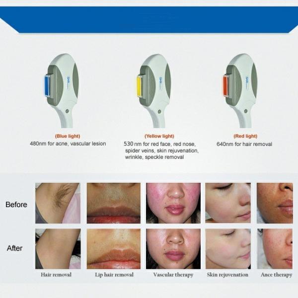 Three Different Wavelength Opt Ipl Nd Yag Laser Hair Removal Machine
