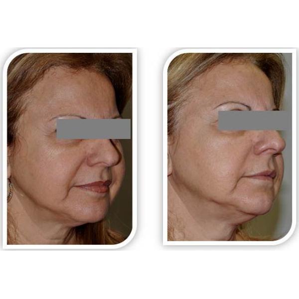 RF bodying slimming equipment