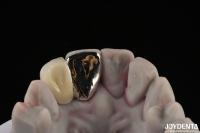 Le pont de Maryland est un pont dentaire métallique, avec une bonne fonction de mastication pour une réparation durable.