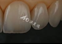 Chipping Resistance  Zirconia Dental Crown For Anterior Teeth / Posterior Teeth
