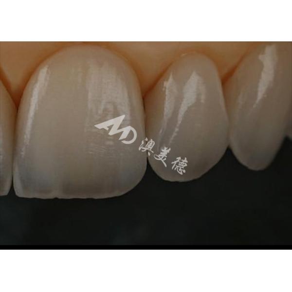 Устойчивость к трещинам Циркониевая зубная корона для передних / задних зубов