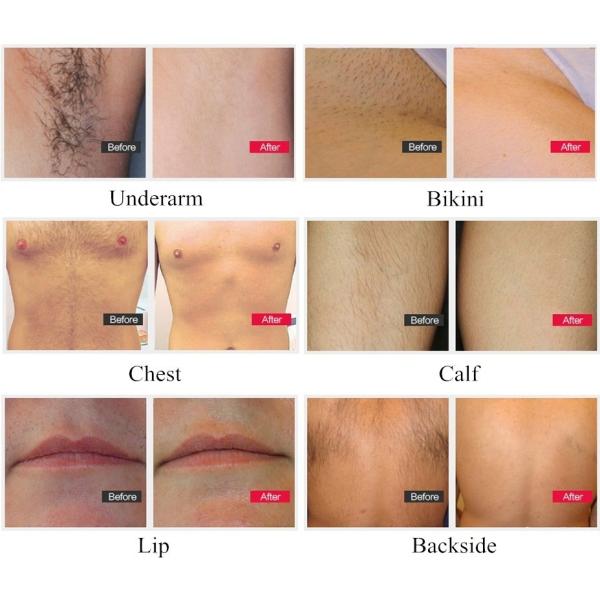 12*35mm Spot Size 808nm Diode Hair Removal Laser Diodo Beauty Machine with Materials